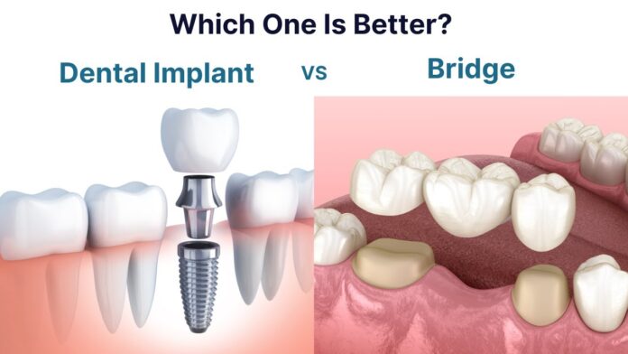 dental-implant-vs-bridge