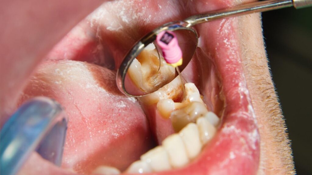 How Long Does a Root Canal Take on a Molar?