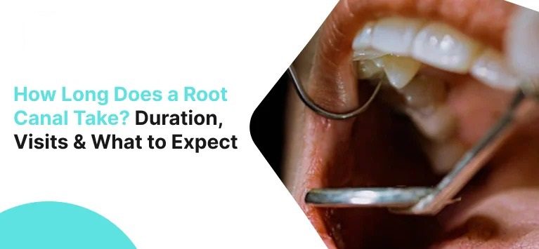 How Long Does It Take to Get a Root Canal?