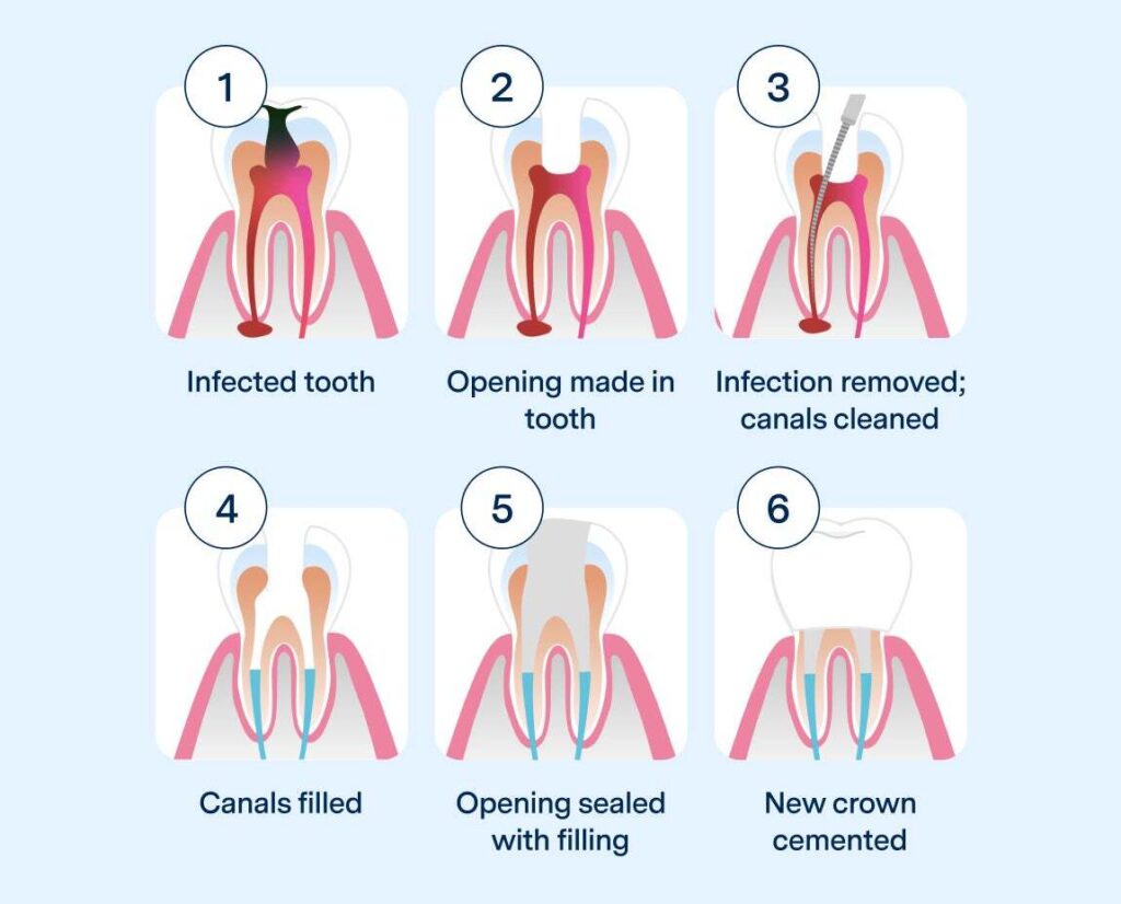 How Long Does a Root Canal Take to Heal?