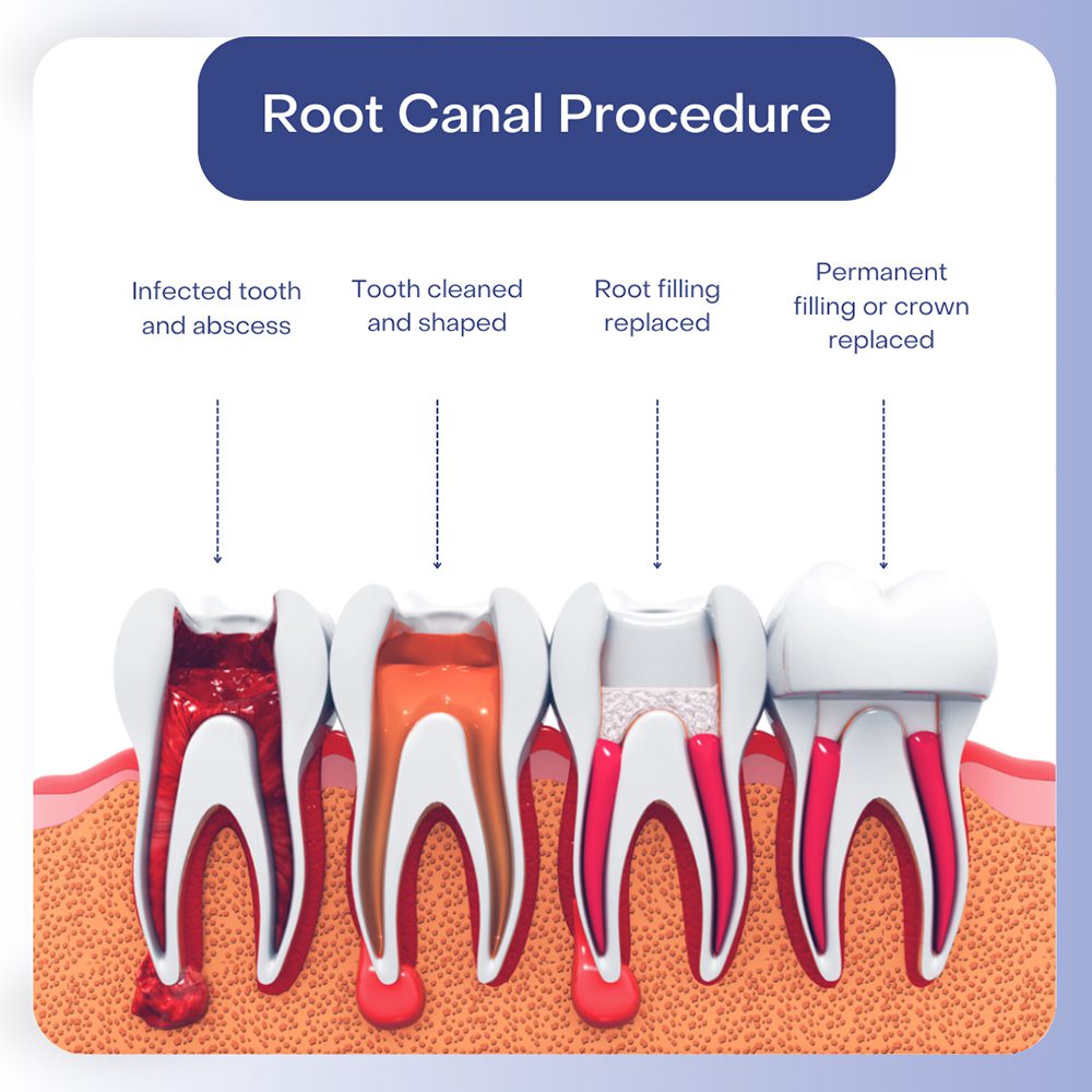 What Happens During a Root Canal Procedure?